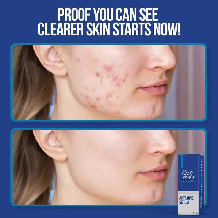 Wiki Special Acne Serum